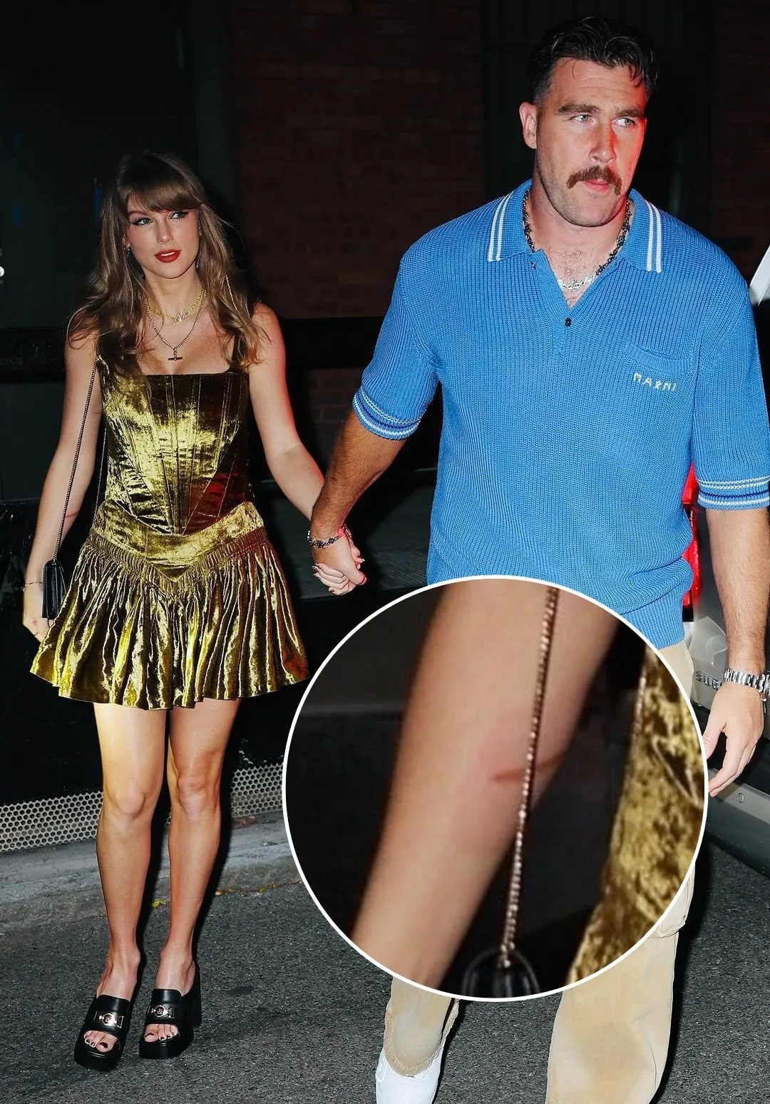 Fans have recently spotted Taylor Swift's noticeable burn injury in photos taken with Travis Kelce.